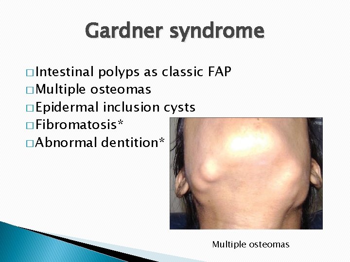 Gardner syndrome � Intestinal polyps as classic FAP � Multiple osteomas � Epidermal inclusion