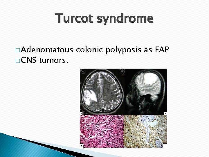 Turcot syndrome � Adenomatous � CNS tumors. colonic polyposis as FAP Turcot syndrome � Adenomatous � CNS tumors. colonic polyposis as FAP