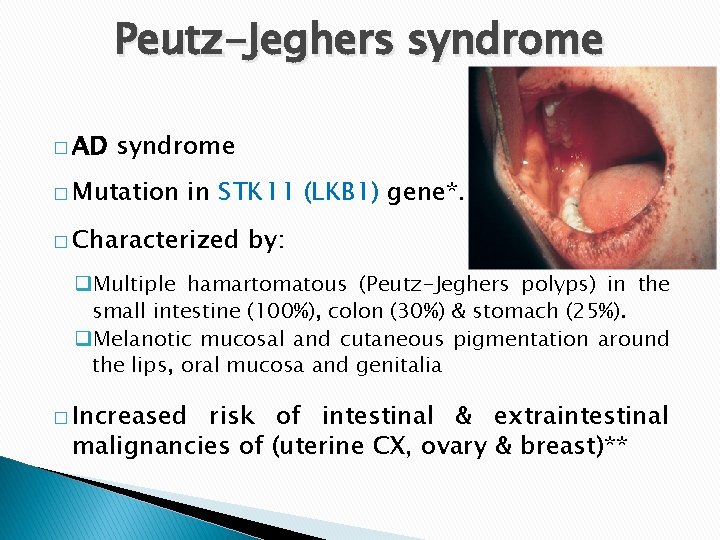 Peutz-Jeghers syndrome � AD syndrome � Mutation in STK 11 (LKB 1) gene*. �