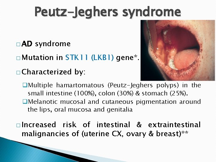 Peutz-Jeghers syndrome � AD syndrome � Mutation in STK 11 (LKB 1) gene*. � Peutz-Jeghers syndrome � AD syndrome � Mutation in STK 11 (LKB 1) gene*. �