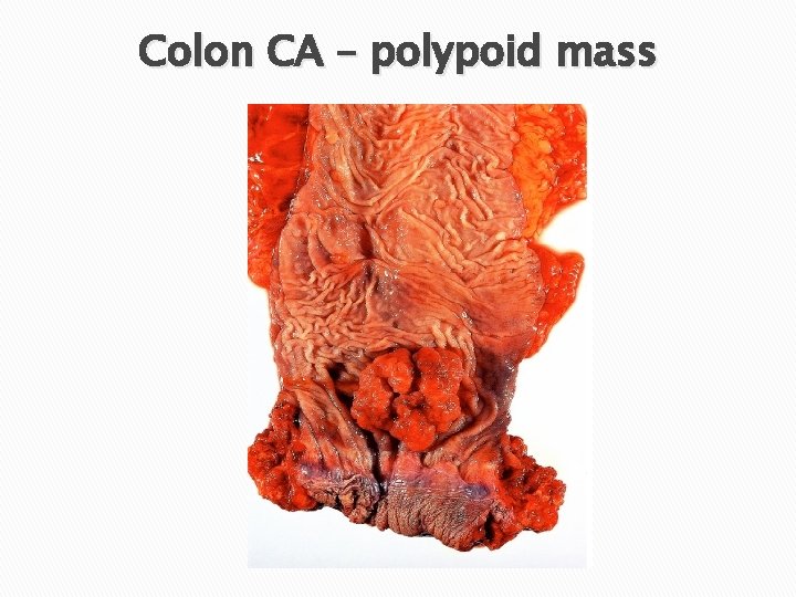 Colon CA – polypoid mass 