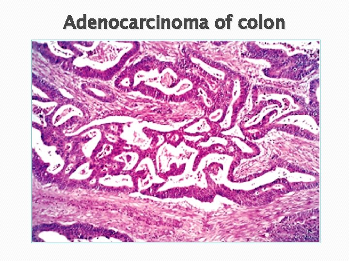 Adenocarcinoma of colon 