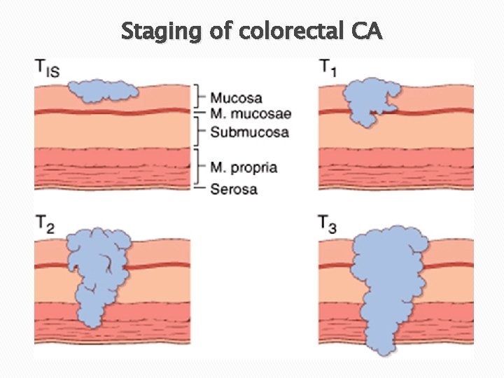 Staging of colorectal CA Staging of colorectal CA