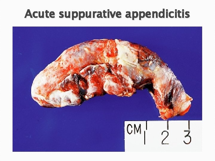 Acute suppurative appendicitis 