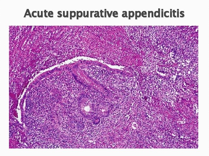 Acute suppurative appendicitis 