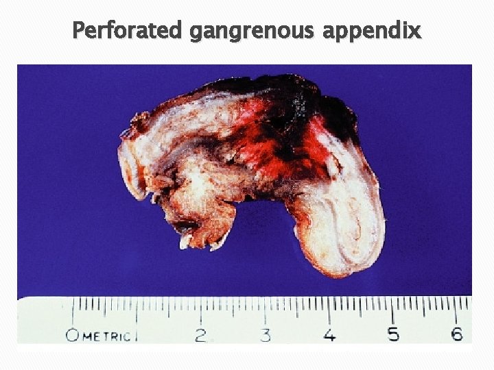Perforated gangrenous appendix 