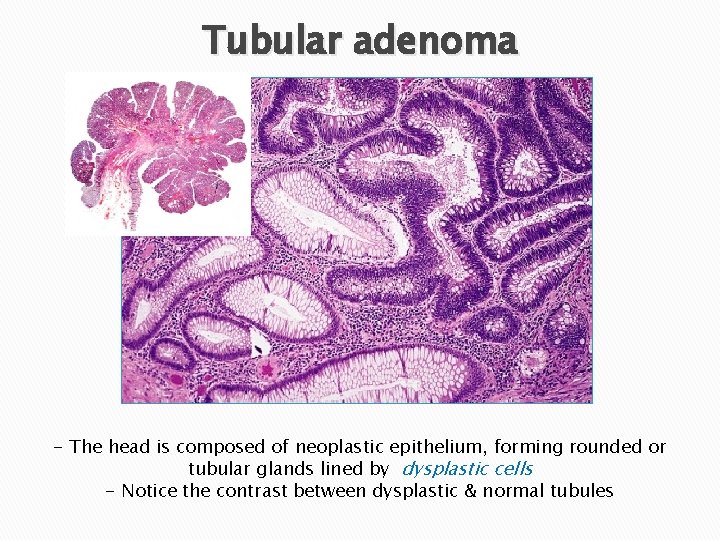 Tubular adenoma - The head is composed of neoplastic epithelium, forming rounded or tubular Tubular adenoma - The head is composed of neoplastic epithelium, forming rounded or tubular