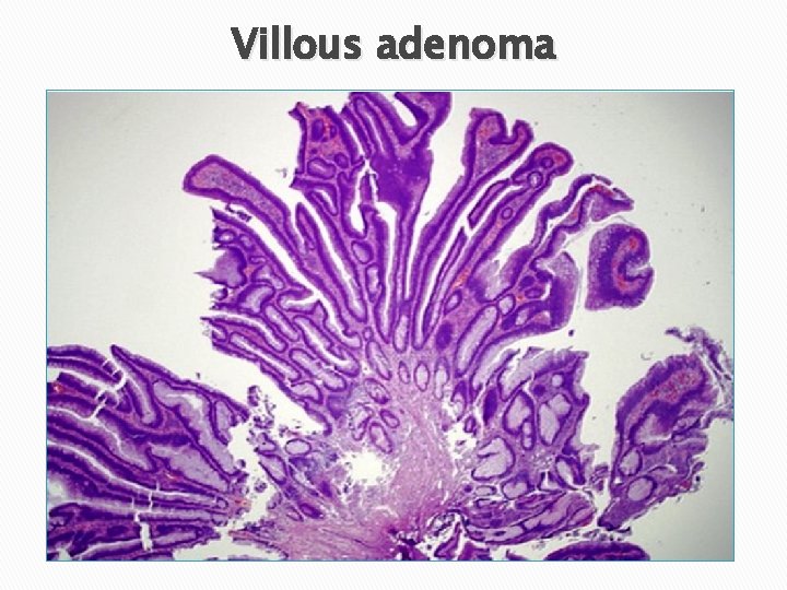 Villous adenoma 