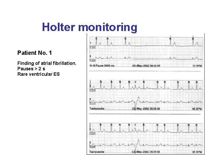 Holter monitoring Patient No. 1 Finding of atrial fibrillation. Pauses > 2 s Rare