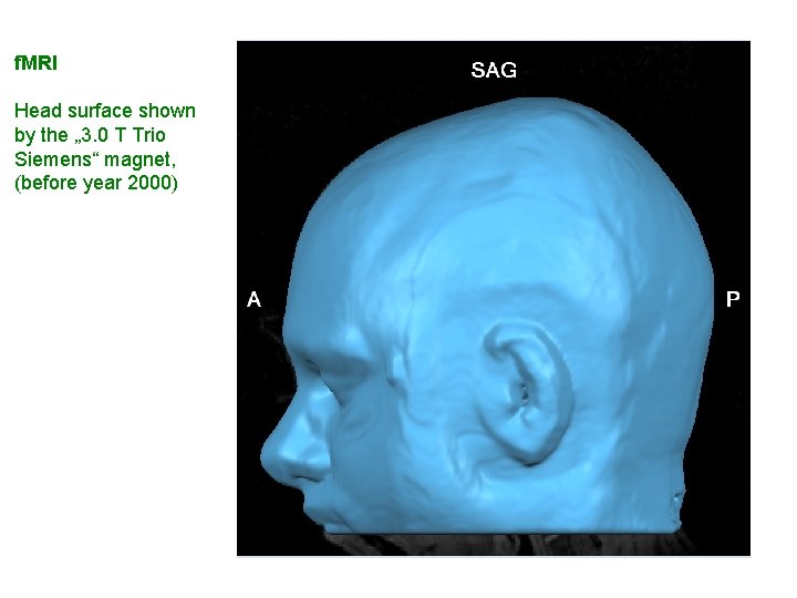 f. MRI Head surface shown by the „ 3. 0 T Trio Siemens“ magnet,