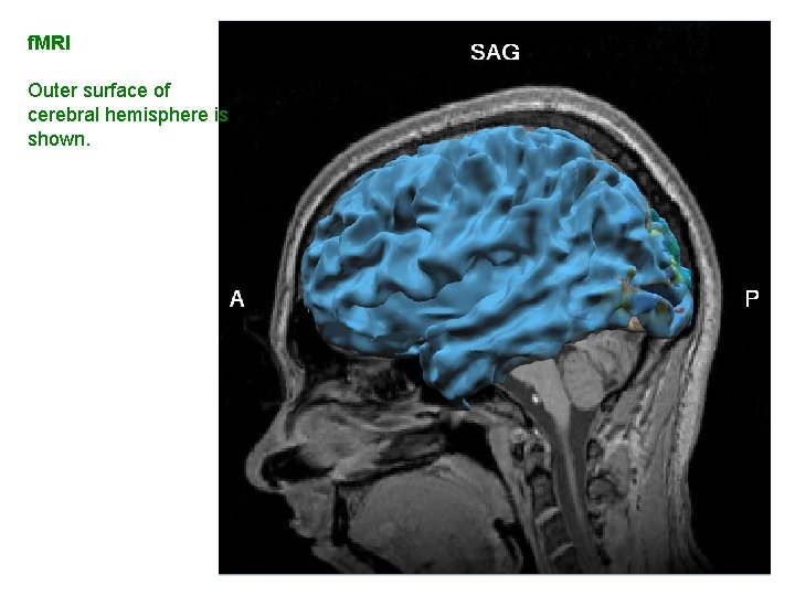 f. MRI Outer surface of cerebral hemisphere is shown. 