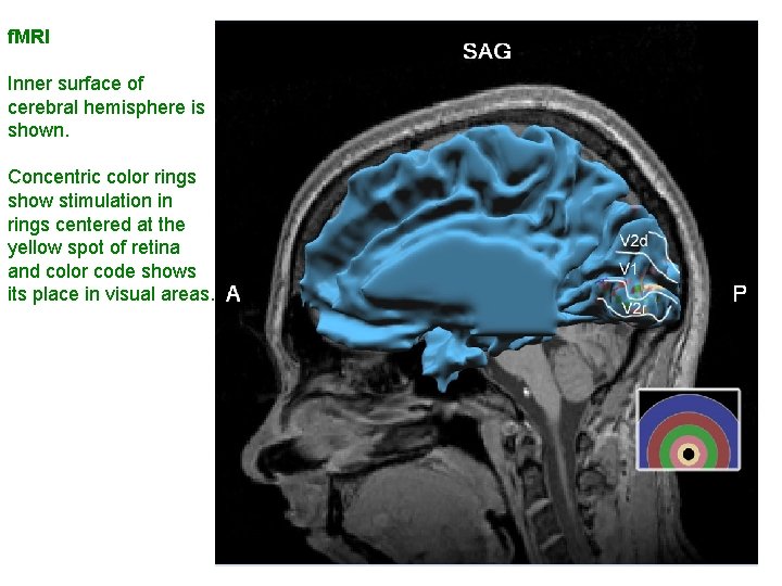 f. MRI Inner surface of cerebral hemisphere is shown. Concentric color rings show stimulation