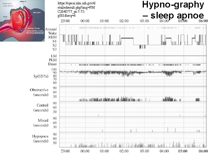 https: //openi. nlm. nih. gov/d etailedresult. php? img=PM C 2848777_pi-7 -75 g 001&req=4 Hypno-graphy