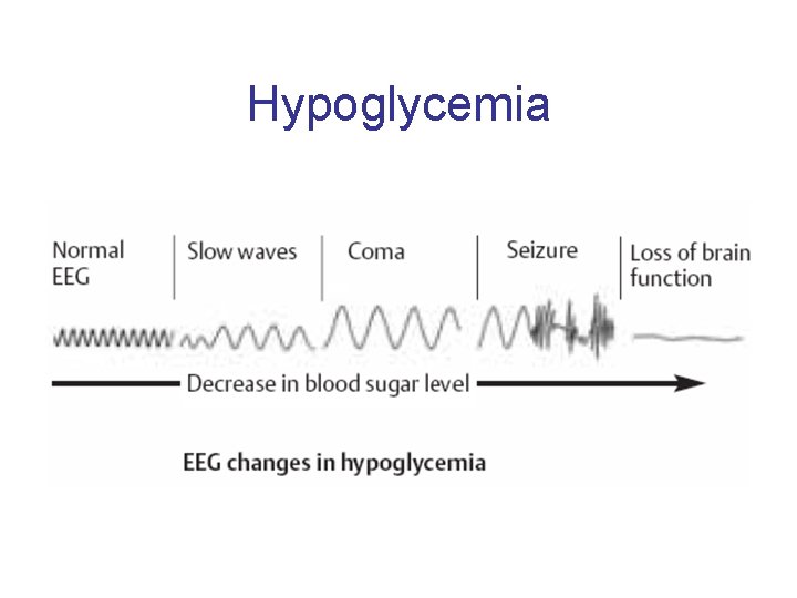 Hypoglycemia 