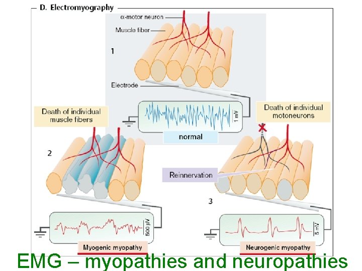 EMG – myopathies and neuropathies 