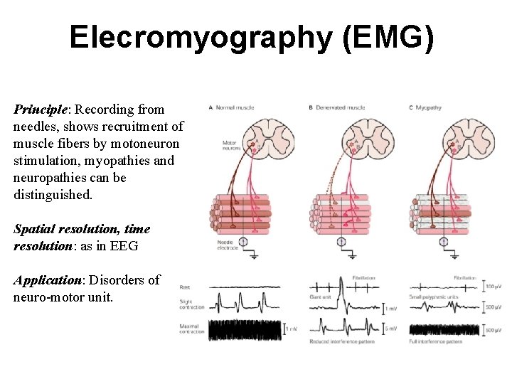 Elecromyography (EMG) Principle: Recording from needles, shows recruitment of muscle fibers by motoneuron stimulation,