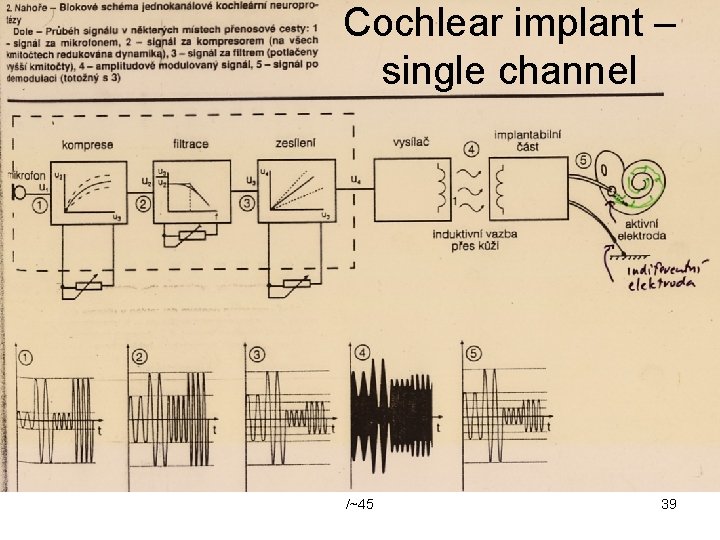 Cochlear implant – single channel /~45 39 