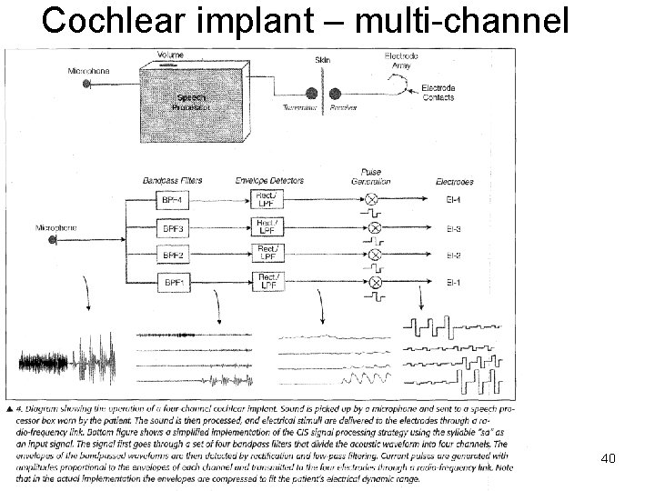 Cochlear implant – multi-channel /~45 40 