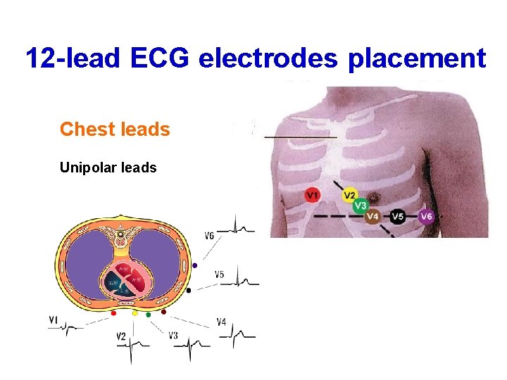 12 -lead ECG electrodes placement Chest leads Unipolar leads 