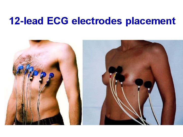 12 -lead ECG electrodes placement 
