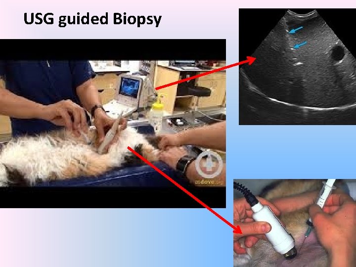 USG guided Biopsy 