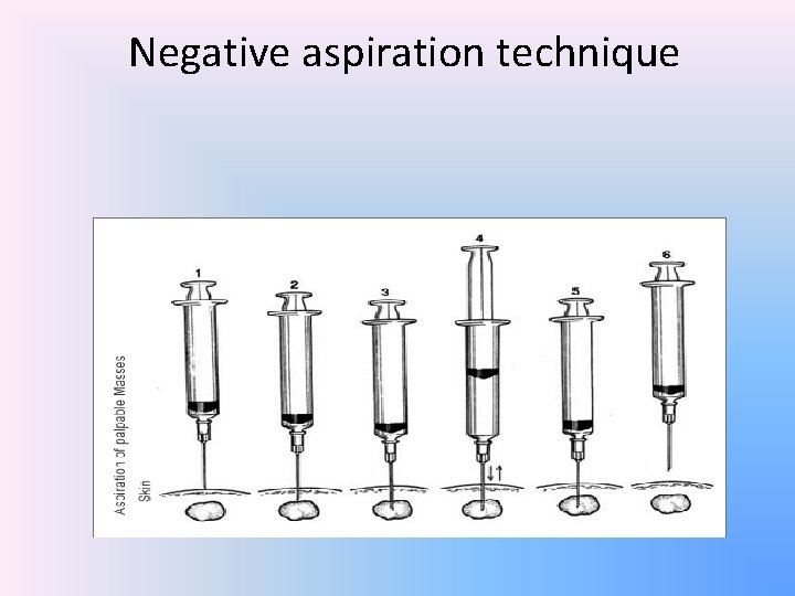 Negative aspiration technique 