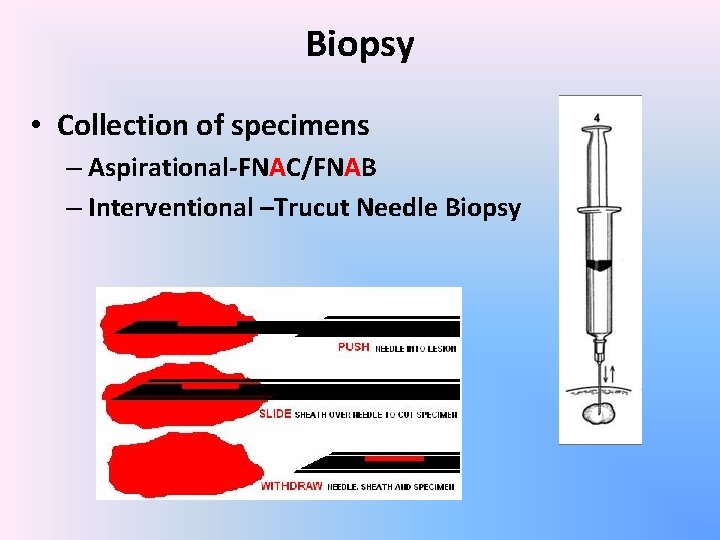 Biopsy • Collection of specimens – Aspirational-FNAC/FNAB – Interventional –Trucut Needle Biopsy 