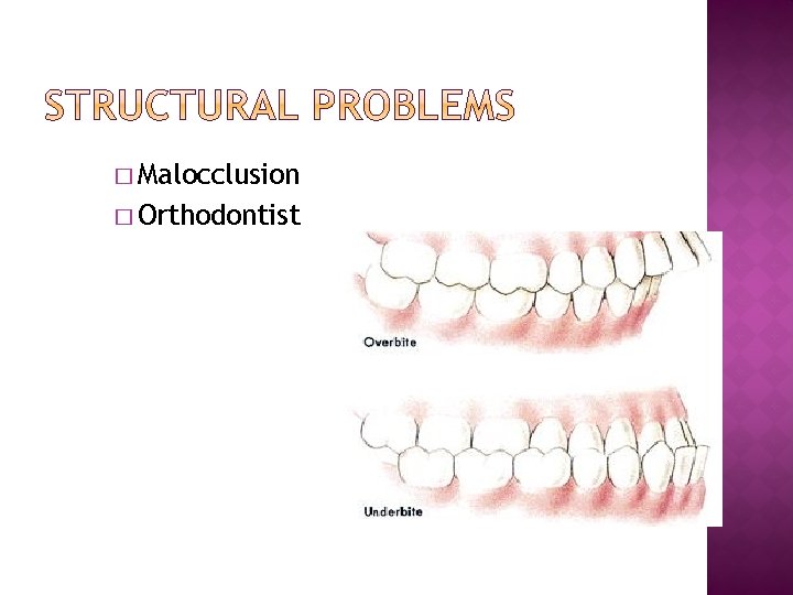 � Malocclusion � Orthodontist 