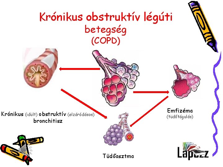 Krónikus obstruktív légúti betegség (COPD) Krónikus obstruktív bronchitisz (idült) Emfizéma (elzáródásos) (tüdőtágulás) Tüdőasztma 