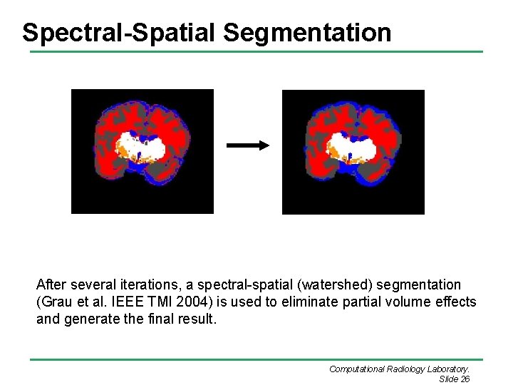 Spectral-Spatial Segmentation After several iterations, a spectral-spatial (watershed) segmentation (Grau et al. IEEE TMI Spectral-Spatial Segmentation After several iterations, a spectral-spatial (watershed) segmentation (Grau et al. IEEE TMI