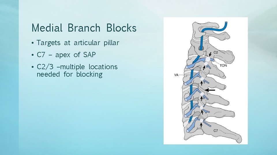 Medial Branch Blocks • Targets at articular pillar • C 7 – apex of