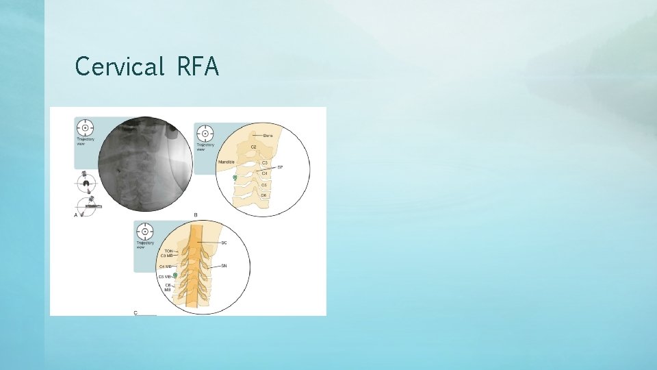 Cervical RFA 