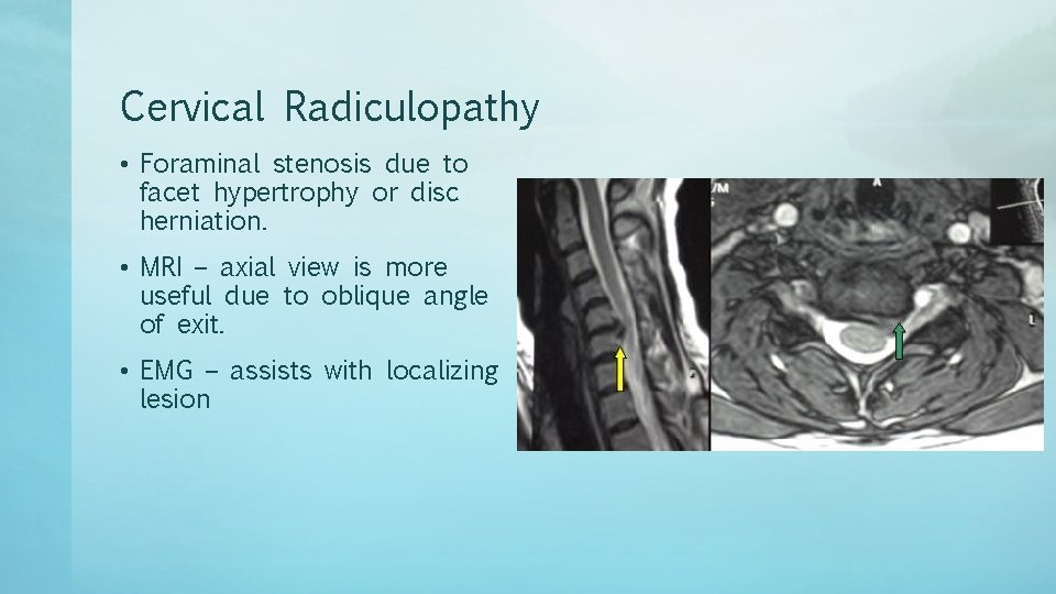 Cervical Radiculopathy • Foraminal stenosis due to facet hypertrophy or disc herniation. • MRI