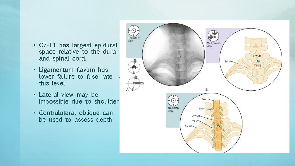  • C 7 -T 1 has largest epidural space relative to the dura