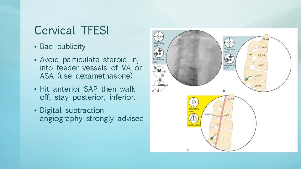 Cervical TFESI • Bad publicity • Avoid particulate steroid inj into feeder vessels of