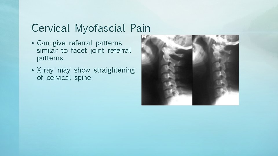 Cervical Myofascial Pain • Can give referral patterns similar to facet joint referral patterns
