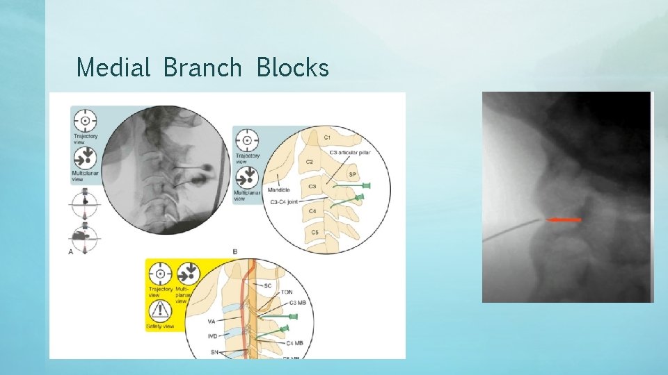 Medial Branch Blocks 