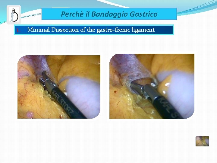 Perchè il Bandaggio Gastrico 1. Minimal Dissection of the gastro-frenic ligament 