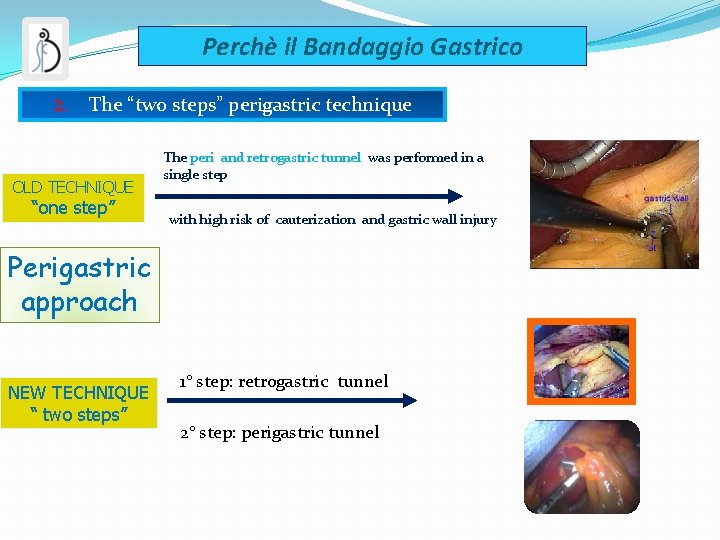 Perchè il Bandaggio Gastrico 2. The “two steps” perigastric technique OLD TECHNIQUE “one step”