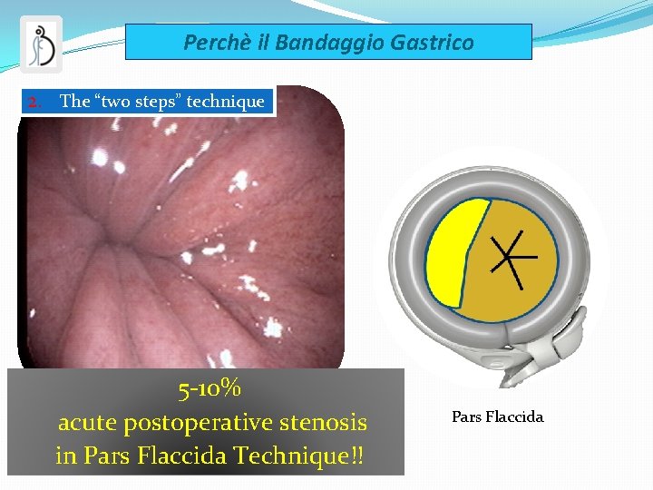 Perchè il Bandaggio Gastrico 2. The “two steps” technique Perigastric 5 -10% acute postoperative