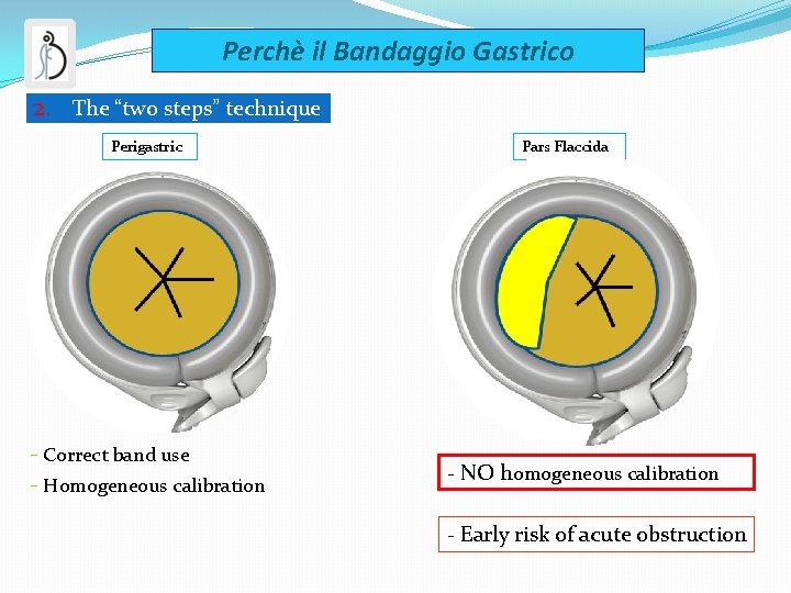 Perchè il Bandaggio Gastrico 2. The “two steps” technique Perigastric - Correct band use