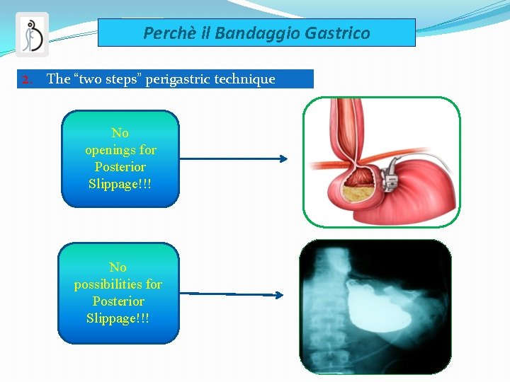 Perchè il Bandaggio Gastrico 2. The “two steps” perigastric technique No openings for Posterior