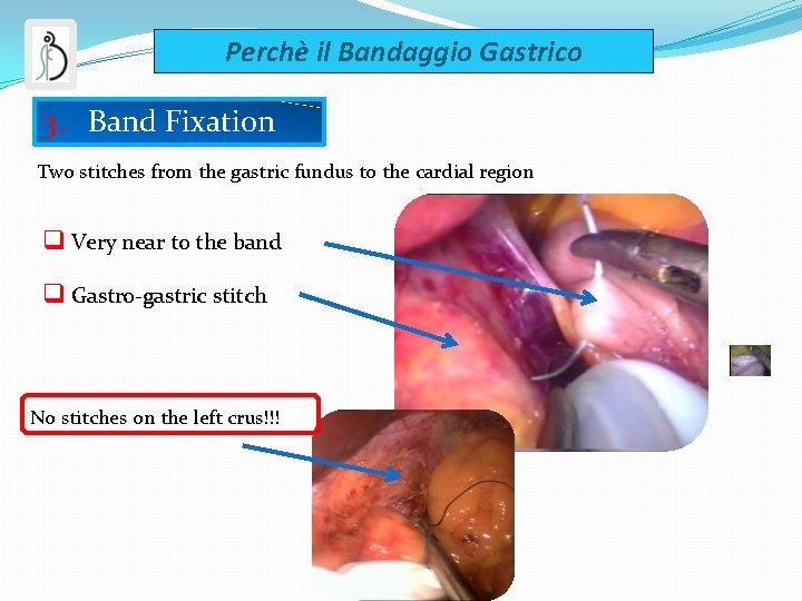 Perchè il Bandaggio Gastrico 3. Band Fixation Two stitches from the gastric fundus to