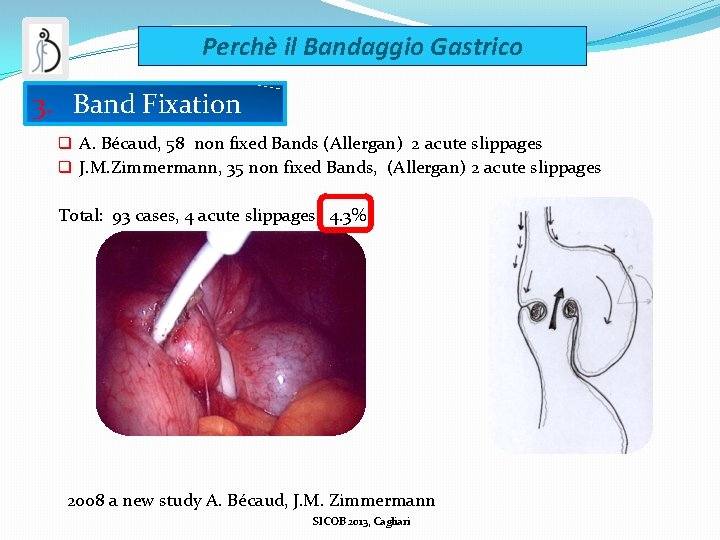 Perchè il Bandaggio Gastrico 3. Band Fixation q A. Bécaud, 58 non fixed Bands