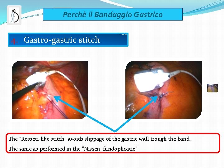 Perchè il Bandaggio Gastrico 4. Gastro-gastric stitch The “Rosseti-like stitch” avoids slippage of the