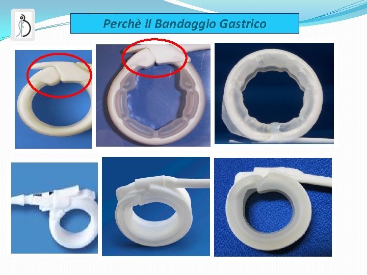 Perchè il Bandaggio Gastrico 