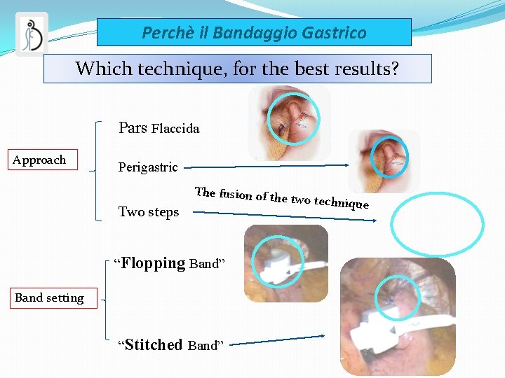 Perchè il Bandaggio Gastrico Which technique, for the best results? Pars Flaccida Approach Perigastric