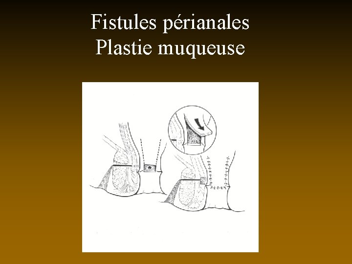 Fistules périanales Plastie muqueuse 