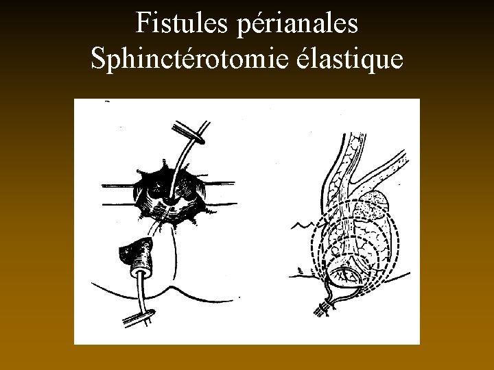 Fistules périanales Sphinctérotomie élastique 