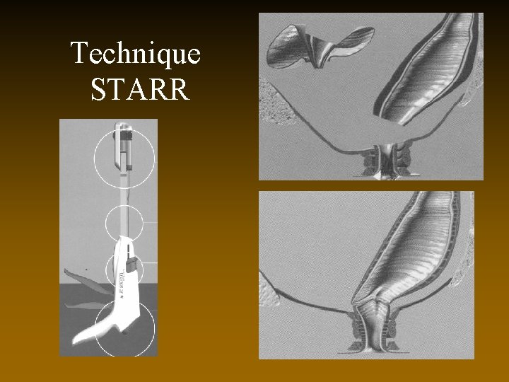 Technique STARR 